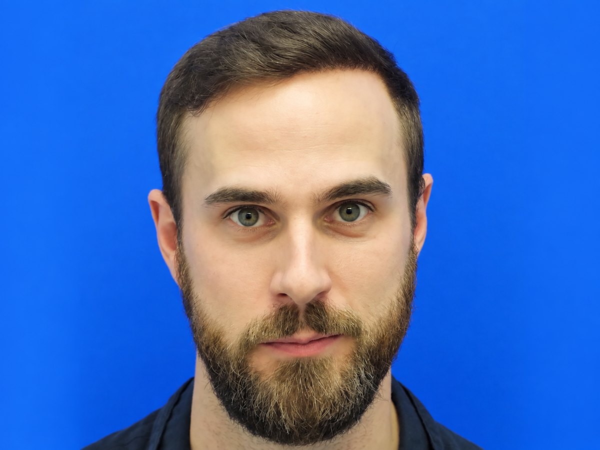 Hair transplant after treatment