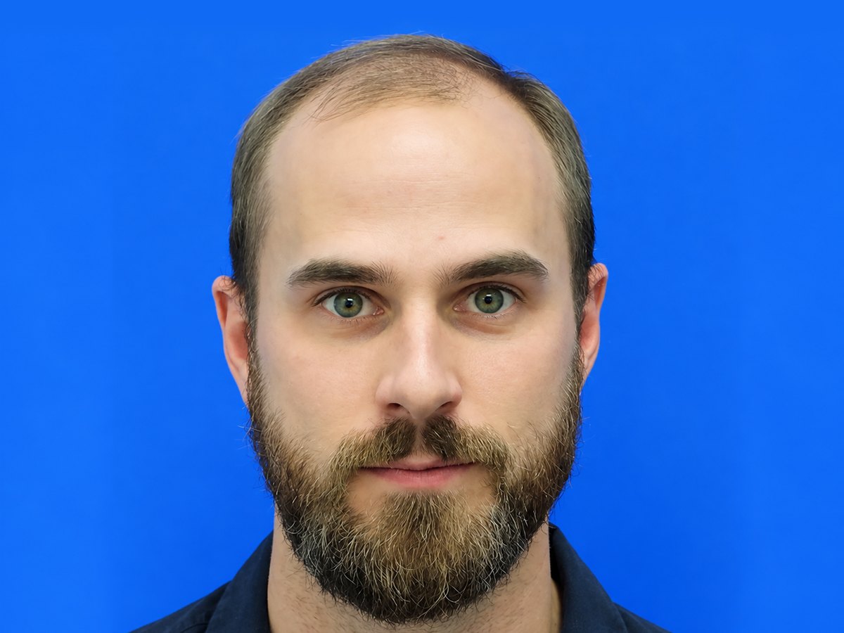 Hair transplant before treatment